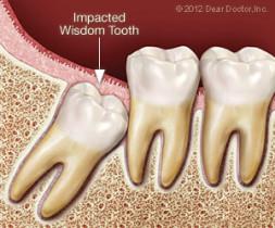 impacted-wisdom-tooth