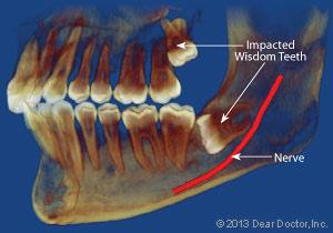 impacted-wisdom-tooth-xray