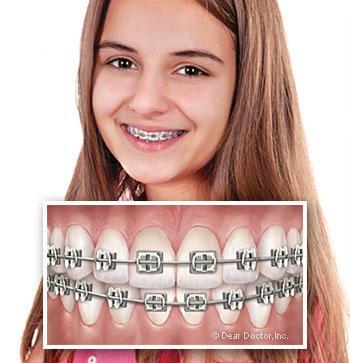 orthodontic-appliances_02