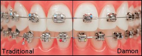 การจัดฟันแบบติดแน่น 2 ประเภท โดยคลินิกทันตแพทย์สว่าง รังสิต