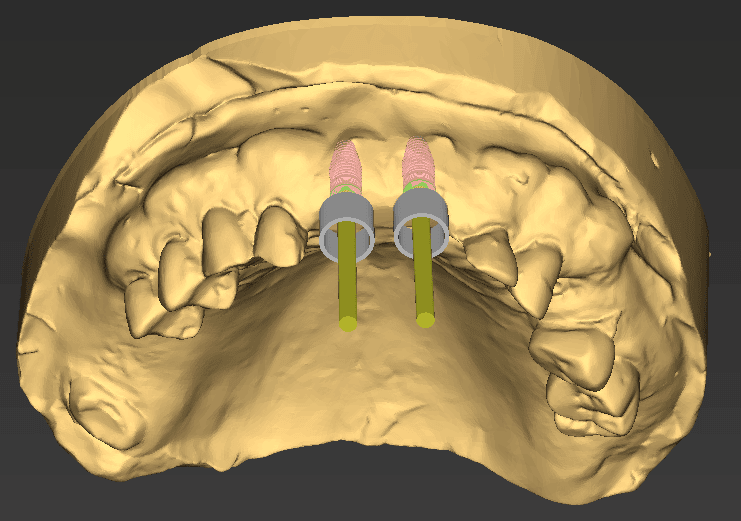 Surgical guide