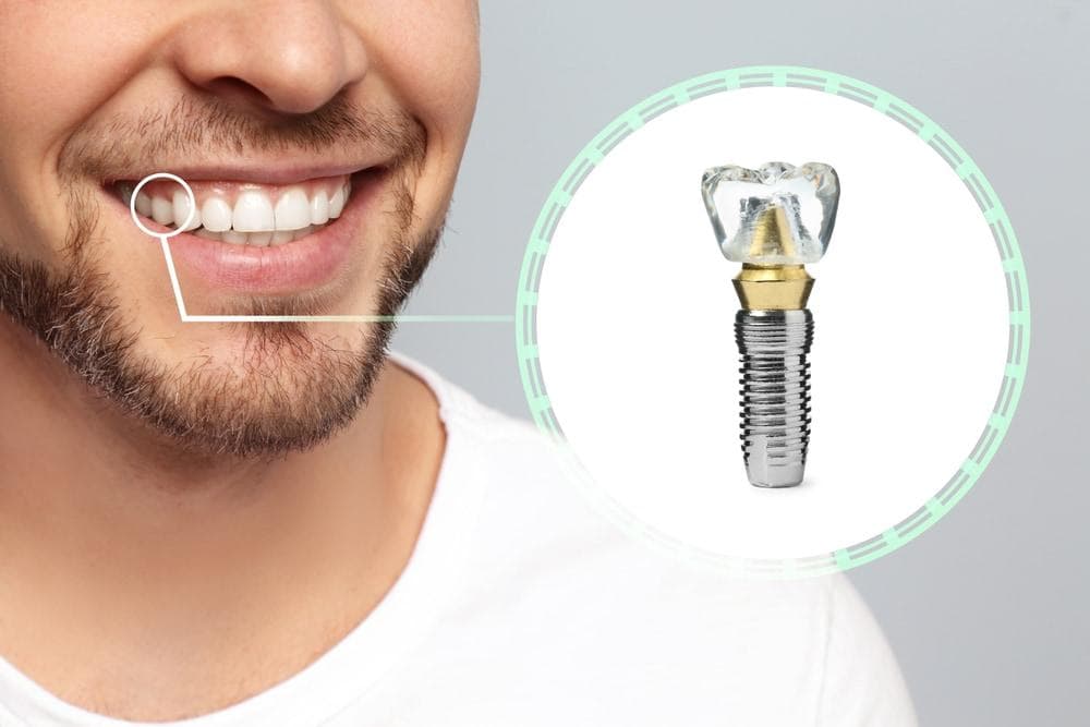 รากฟันเทียมอักเสบเกิดจากอะไรได้บ้าง