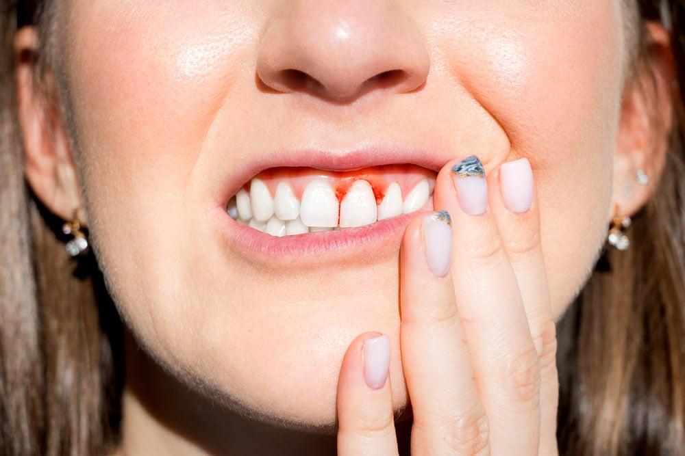 ผู้หญิงมีอาการเลือดออกตามไรฟัน