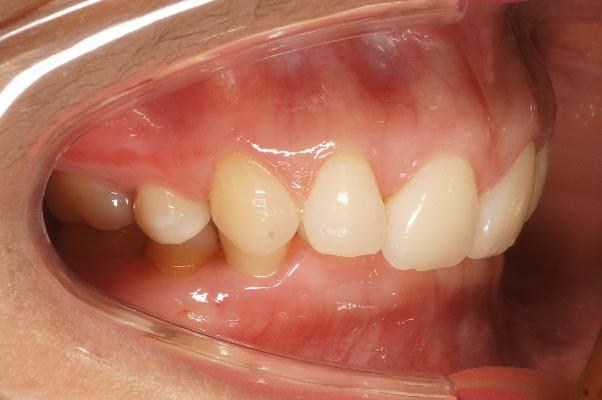 อาการฟันงุ้มที่ฟันหน้าบนที่ยื่นออกมาน้อยกว่าปกติ